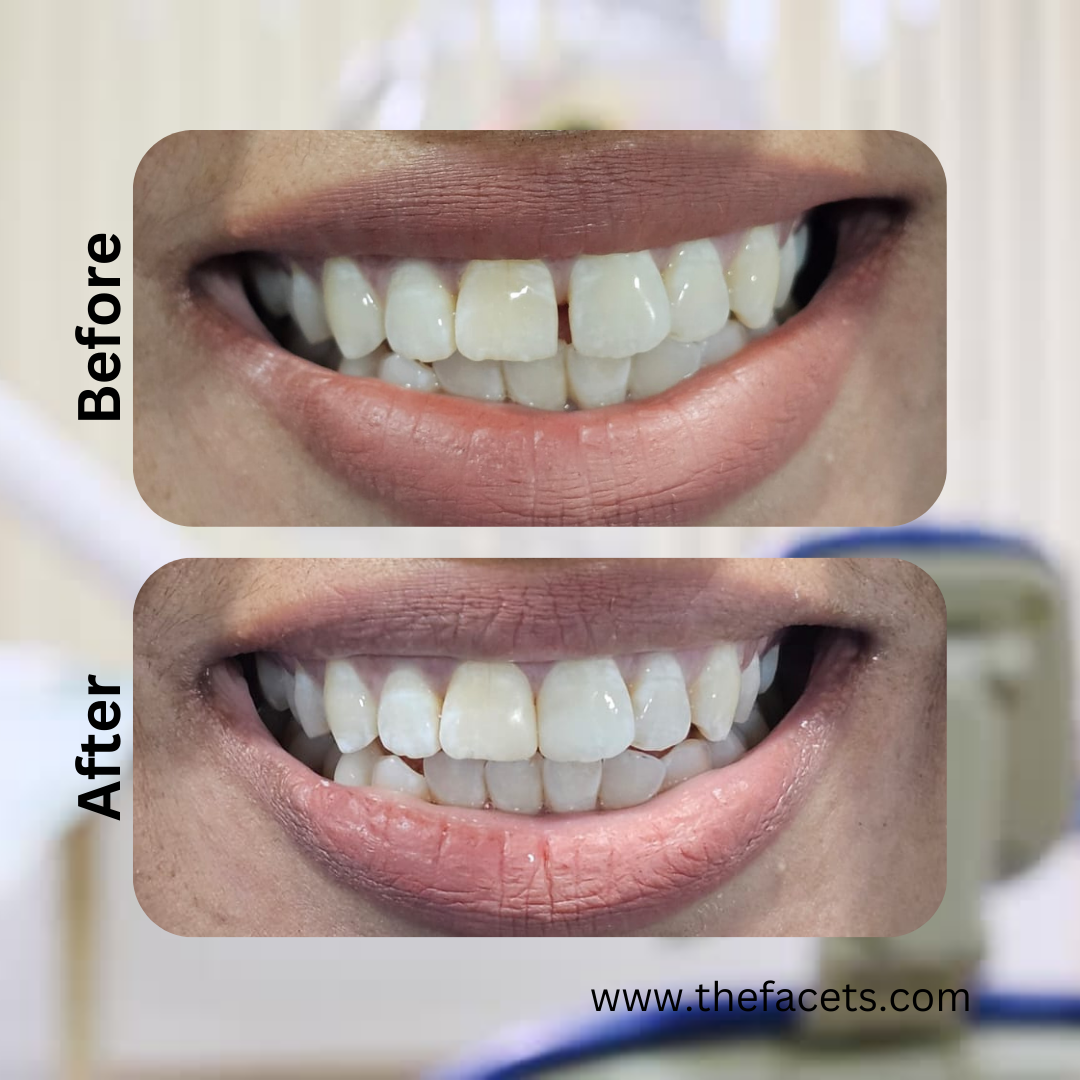 Before After Result 7
